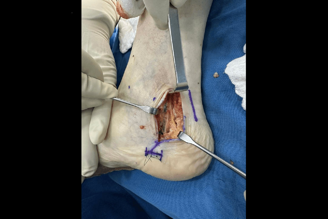 Fascitis plantar 2