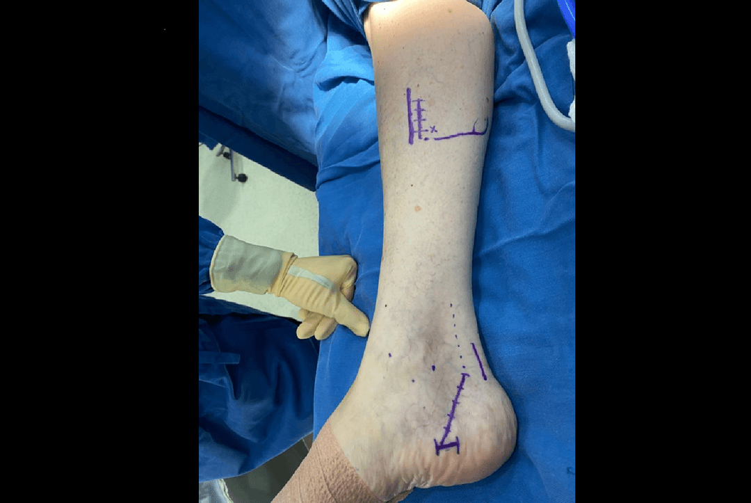 Fascitis plantar 3