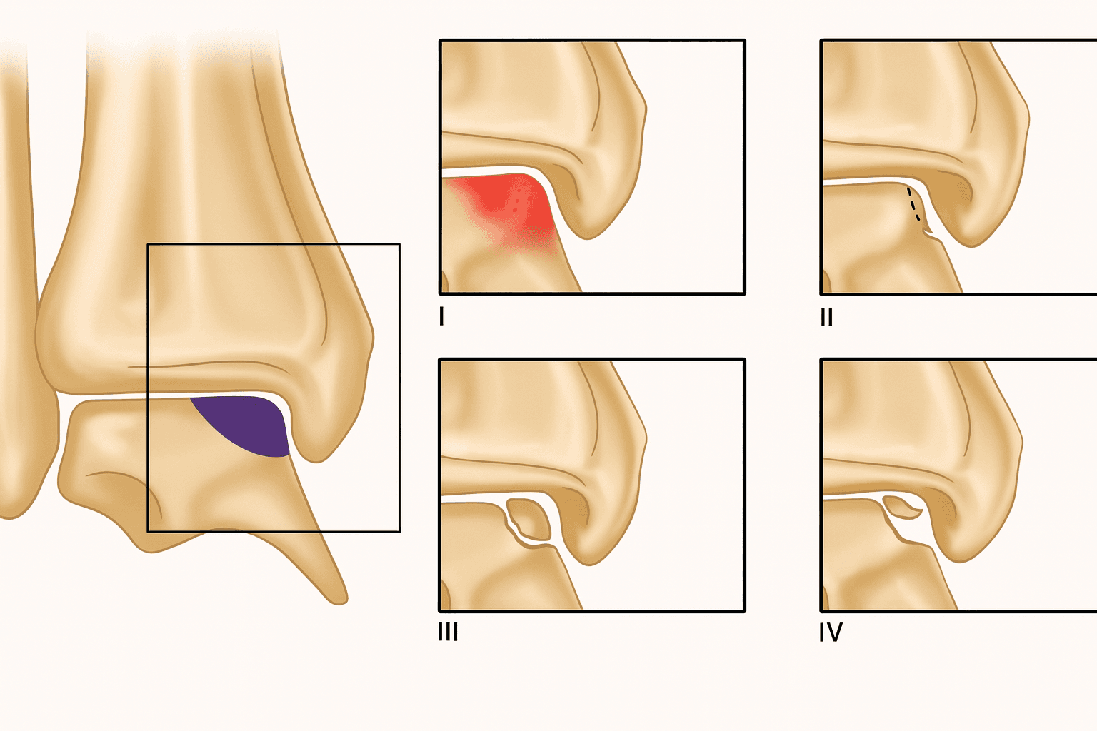 Lesiones osteocondrales 1