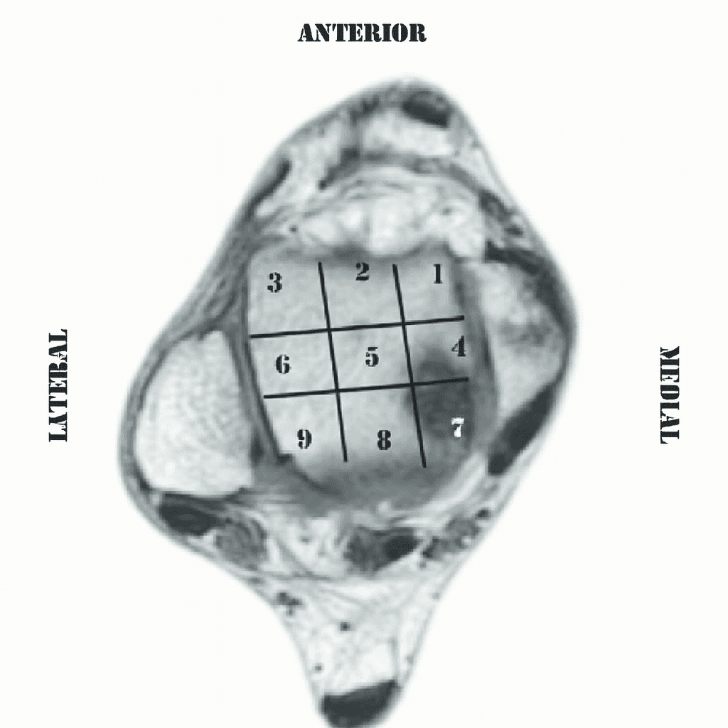 Lesiones osteocondrales 2