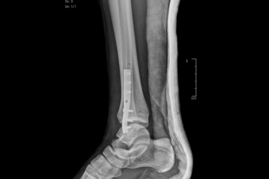 Lesiones osteocondrales 3