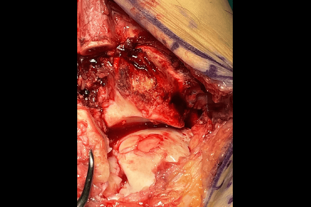 Lesiones osteocondrales 4