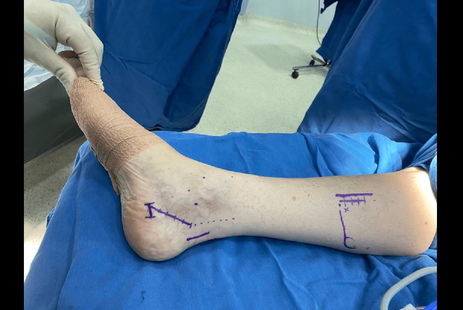 Fascitis plantar 1