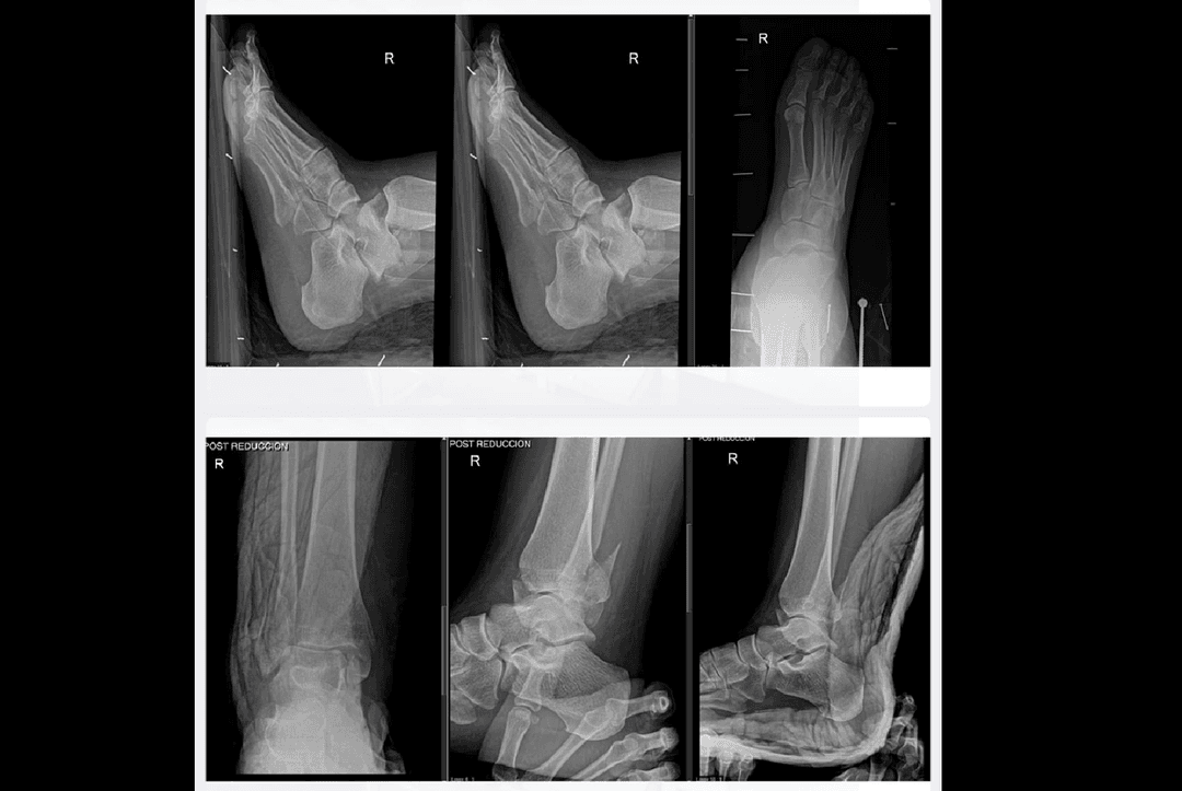Fracturas de tobillo y pie 1