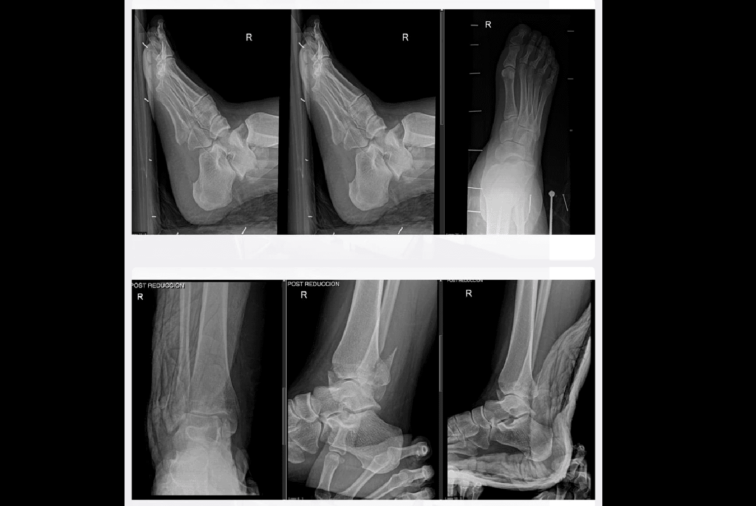 Fracturas de tobillo y pie 1