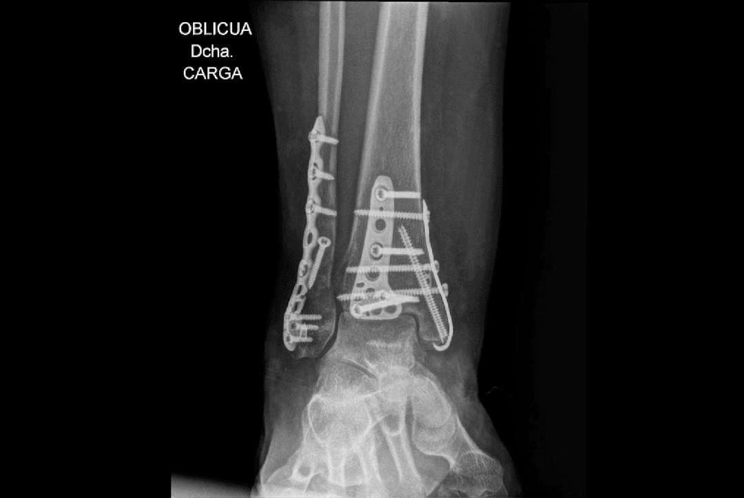 Fracturas de tobillo y pie 4